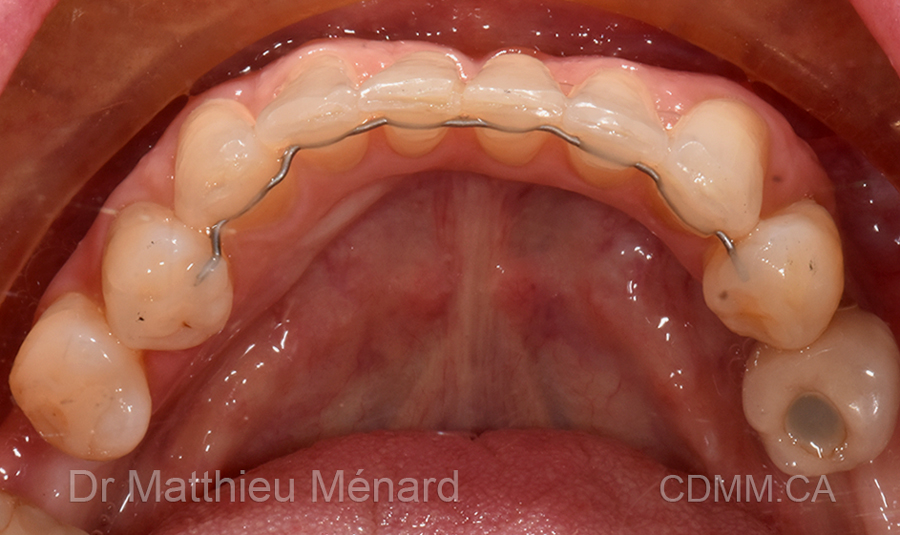 Invisalign après