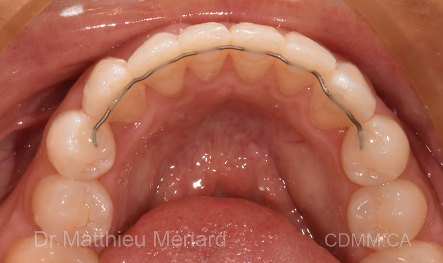 Invisalign après