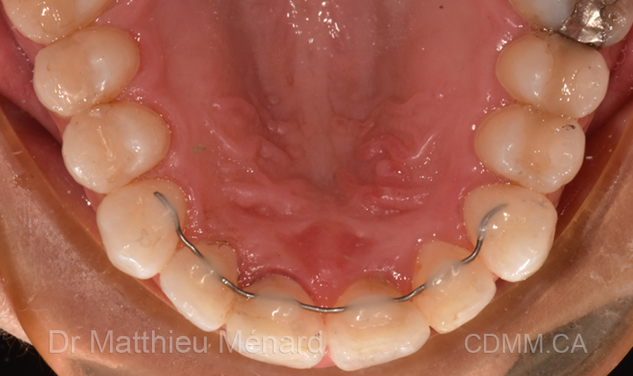 Invisalign après