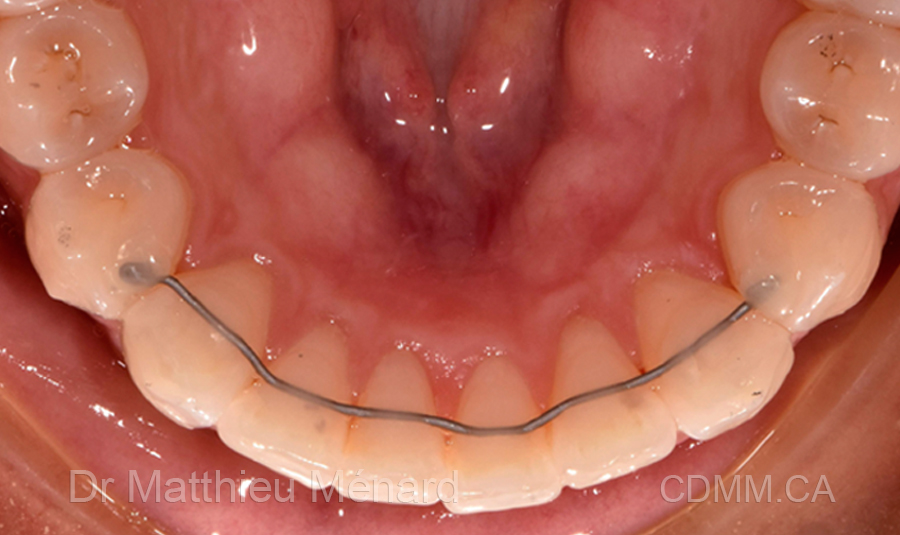 Invisalign après