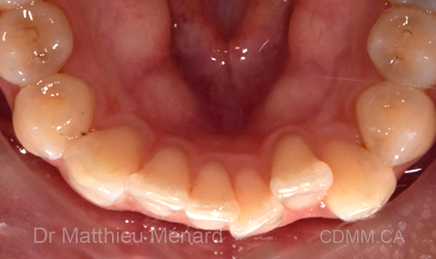 Invisalign après