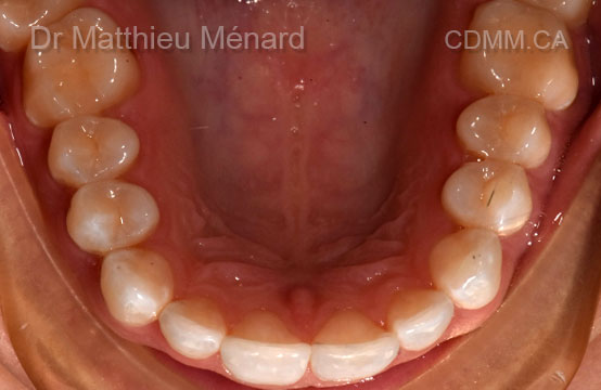 Invisalign après