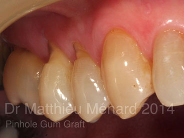 Pinhole-Gum-Graft-greffe-de-genvcive-1