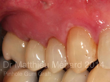 Pinhole-Gum-Graft-greffe-de-genvcive-2