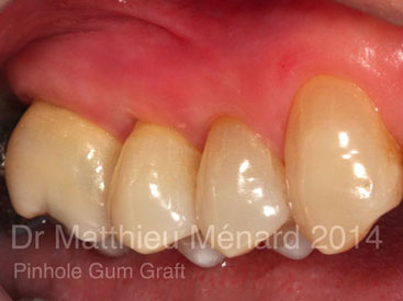 Pinhole-Gum-Graft-greffe-de-genvcive-2