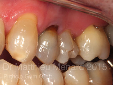 Pinhole-Gum-Graft-greffe-de-genvcive-b1