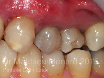 Pinhole-Gum-Graft-greffe-de-genvcive-b2