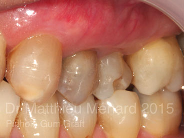 Pinhole-Gum-Graft-greffe-de-genvcive-b3