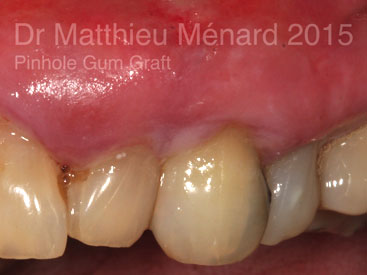 Pinhole-Gum-Graft-greffe-de-genvcive-c2