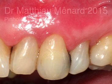 Pinhole-Gum-Graft-greffe-de-genvcive-b3