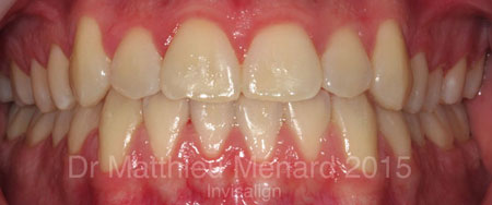 Invisalign First  Dr. Patricia Timmeny