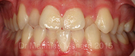 invisalign-greenfield-park-avant