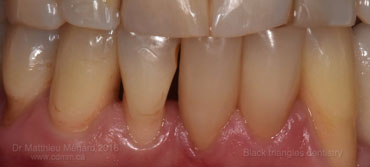 a-space-between-teeth black triangle-1