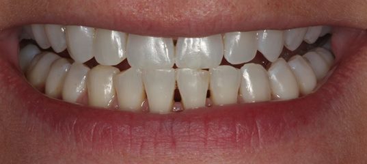 black-triangle-before space-between-teeth