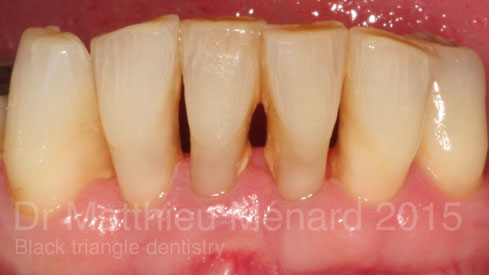 black-triangle-dentistry-apres-b