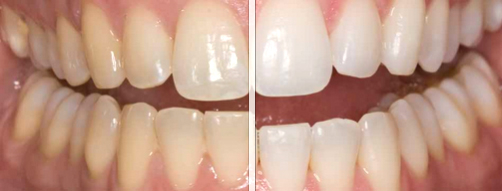 opalescence-before-after Whitening